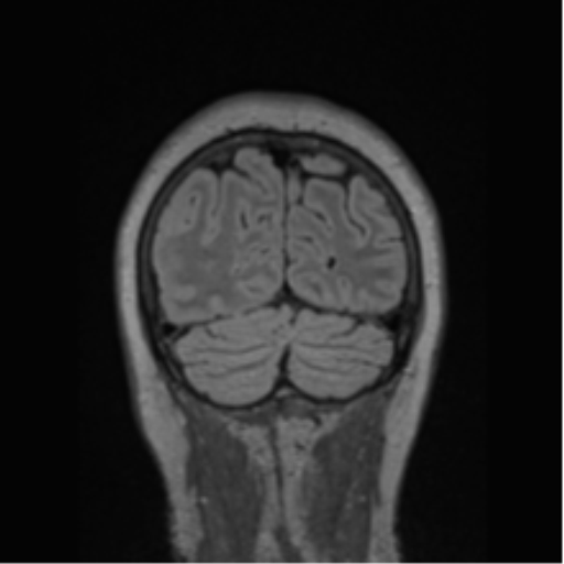 Cerebral abscess from pulmonary arteriovenous malformation (Radiopaedia 86275-102291 Coronal FLAIR 19).png
