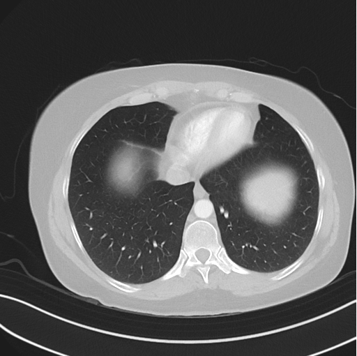Cerebral abscess from pulmonary arteriovenous malformation (Radiopaedia 86275-102292 Axial lung window 45).png