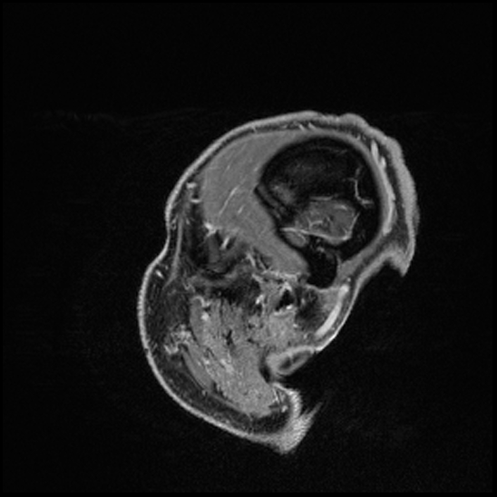 Cerebral abscess with ventriculitis (Radiopaedia 78965-91878 Sagittal T1 C+ 167).jpg