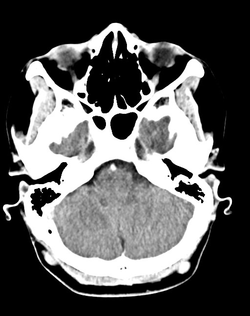 Cerebral abscesses (Radiopaedia 70458-80568 Axial Contrast 17).jpg