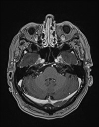 Cerebral amyloid angiopathy-related inflammation (Radiopaedia 58270-65377 Axial T1 C+ fat sat 28).jpg