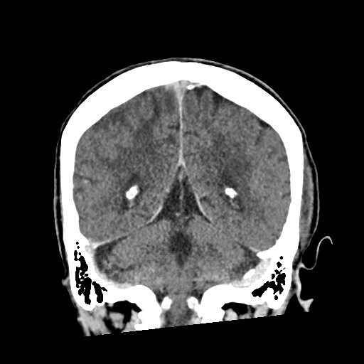 Cerebral amyloid angiopathy-related inflammation (Radiopaedia 74836-85848 Coronal non-contrast 49).jpg
