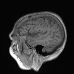 File:Cerebral amyloid angiopathy-related inflammation (Radiopaedia 74836-85849 Sagittal T1 27).jpg