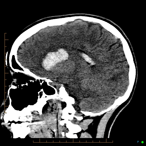 Cerebral arteriovenous malformation (AVM) (Radiopaedia 78162-90706 A 33).jpg
