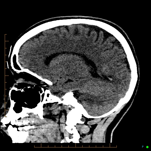 Cerebral arteriovenous malformation (AVM) (Radiopaedia 78162-90706 A 49).jpg