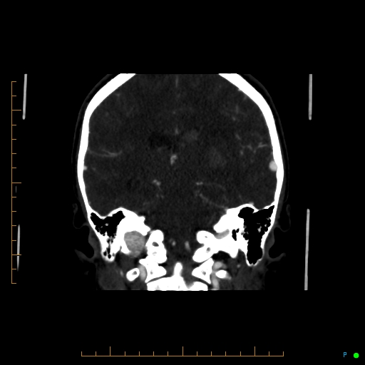 Cerebral arteriovenous malformation (AVM) (Radiopaedia 78162-90706 Coronal CTA 44).jpg