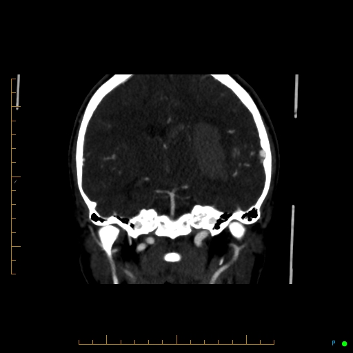 Cerebral arteriovenous malformation (AVM) (Radiopaedia 78162-90706 Coronal CTA 52).jpg