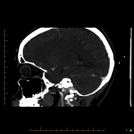 Cerebral arteriovenous malformation (AVM) (Radiopaedia 78162-90706 Sagittal CTA 53).jpg