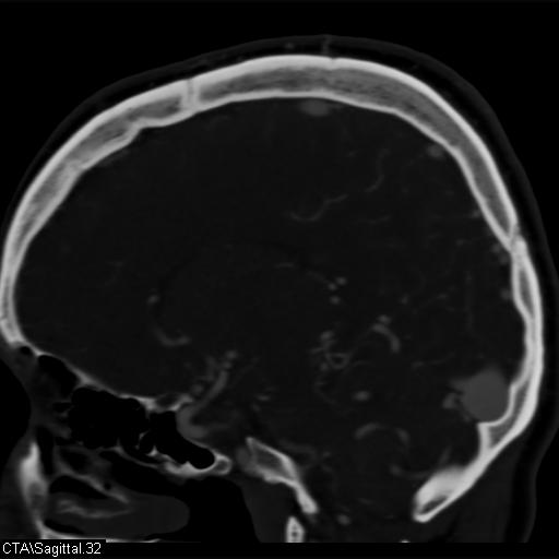 Cerebral arteriovenous malformation (Radiopaedia 28518-28759 D 29).jpg