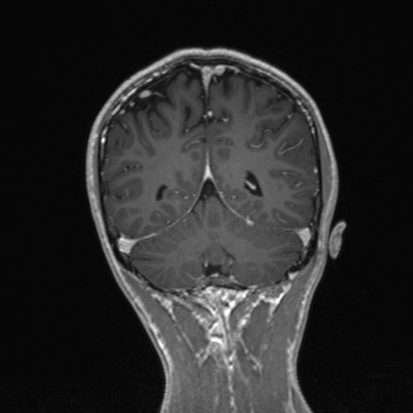 Cerebral arteriovenous malformation (Radiopaedia 30198-30813 F 43).jpg