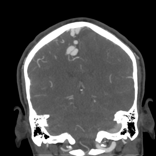 Cerebral arteriovenous malformation (Radiopaedia 39259-41505 E 43).png