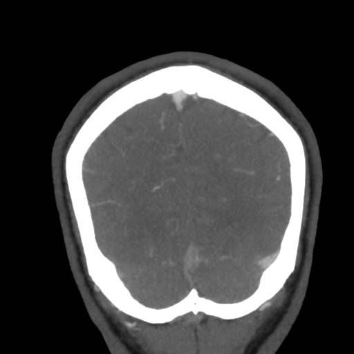 Cerebral arteriovenous malformation (Radiopaedia 39259-41505 E 59).png