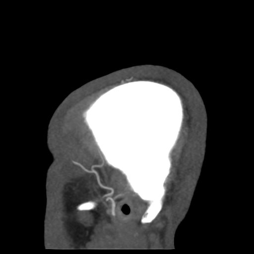 Cerebral arteriovenous malformation (Radiopaedia 39259-41505 Sagittal 58).png
