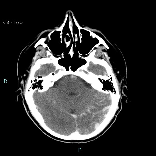 File:Cerebral arteriovenous malformation (Radiopaedia 40528-43125 Axial C+ delayed 10).jpg