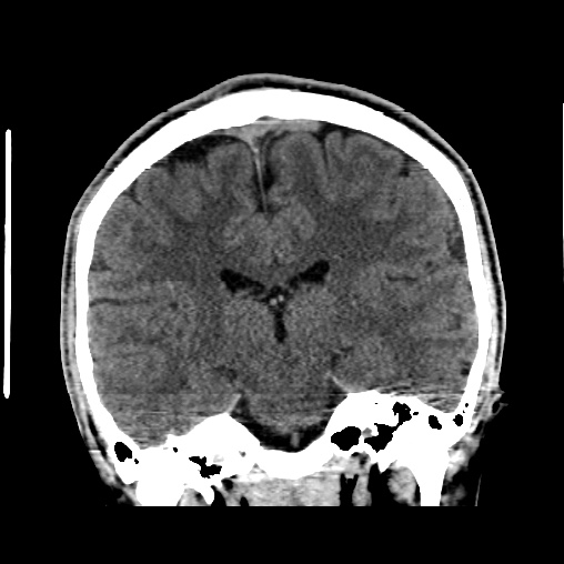 Cerebral arteriovenous malformation (Radiopaedia 61964-70028 Coronal non-contrast 34).jpg