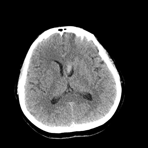 File:Cerebral arteriovenous malformation (Radiopaedia 73830-84645 Axial non-contrast 25).jpg