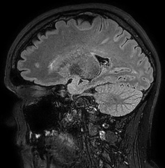 Cerebral arteriovenous malformation (Radiopaedia 74411-85654 Sagittal FLAIR 45).jpg