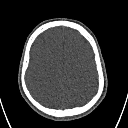 Cerebral arteriovenous malformation (Radiopaedia 78188-90746 Axial non-contrast 136).jpg