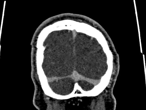 Cerebral arteriovenous malformation (Radiopaedia 78188-90746 Coronal C+ delayed 117).jpg