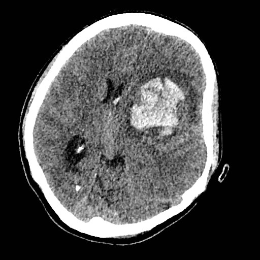 Cerebral arteriovenous malformation (Radiopaedia 79677-92887 Axial non-contrast 19).jpg