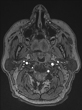 Cerebral arteriovenous malformation (Radiopaedia 84015-99245 Axial TOF 1).jpg