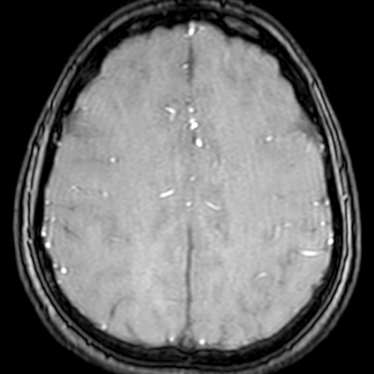 Cerebral arteriovenous malformation at posterior body of corpus callosum (Radiopaedia 74111-84925 Axial MRA 162).jpg