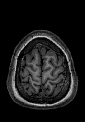 Cerebral arteriovenous malformation at posterior body of corpus callosum (Radiopaedia 74111-84925 Axial T1 18).jpg