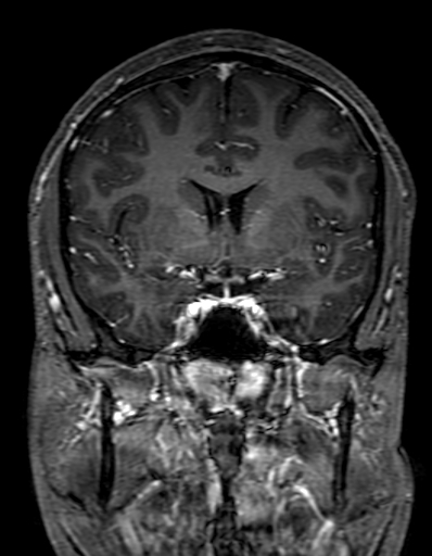 Cerebral arteriovenous malformation at posterior body of corpus callosum (Radiopaedia 74111-84925 K 150).jpg