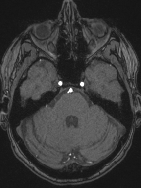 Cerebral arteriovenous malformation with hemorrhage (Radiopaedia 34422-35737 Axial MRA 22).png