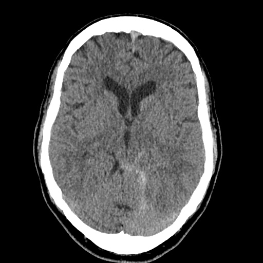 Cerebral arteriovenous malformation with lobar hemorrhage (Radiopaedia 35598-37117 Axial non-contrast 23).jpg