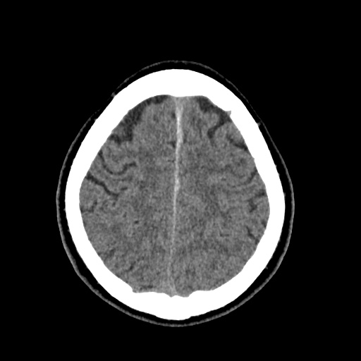 Cerebral arteriovenous malformation with lobar hemorrhage (Radiopaedia 35598-37117 Axial non-contrast 45).jpg