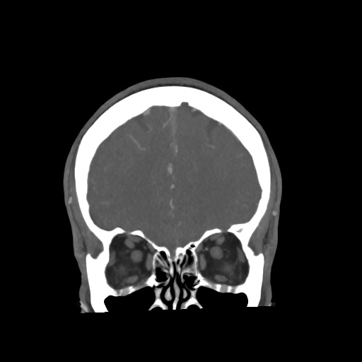 Cerebral arteriovenous malformation with lobar hemorrhage (Radiopaedia 35598-57216 C 21).jpg