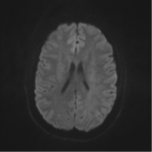 File:Cerebral cavernoma and development venous anomaly (Radiopaedia 37603-39482 Axial DWI 37).png