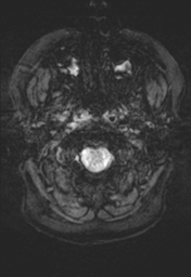 File:Cerebral cavernoma and development venous anomaly (Radiopaedia 37603-39482 Axial SWI 1).png