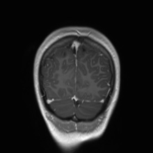 File:Cerebral cavernous venous malformation (Radiopaedia 70008-80021 Coronal T1 C+ 10).jpg