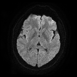 Cerebral cavernous venous malformation (Zabramski type II) (Radiopaedia 85511-101198 Axial DWI 50).jpg