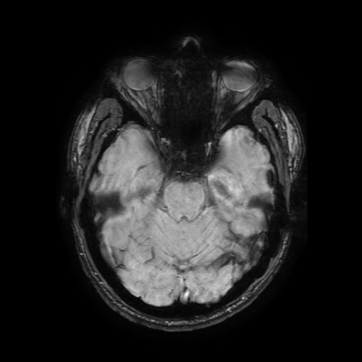 Cerebral cavernous venous malformation (Zabramski type II) (Radiopaedia 85511-101198 Axial SWI 48).jpg