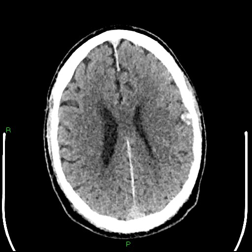 Cerebral contusions (Radiopaedia 33868-35039 Axial non-contrast 140).jpg