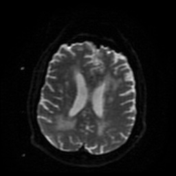 Cerebral embolic infarcts (embolic shower) (Radiopaedia 49837-55108 Axial DWI 17).jpg