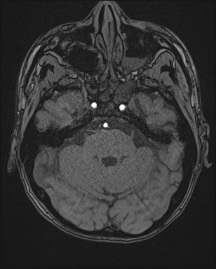 Cerebral embolic infarcts (embolic shower) (Radiopaedia 72391-82921 Axial MRA 34).jpg