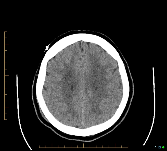 Cerebral fat embolism (Radiopaedia 85521-101220 Axial non-contrast 44).jpg