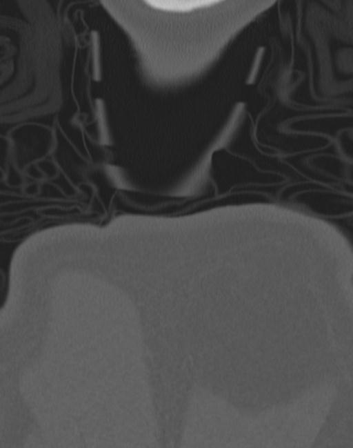Cerebral hemorrhagic contusions and cervical spine fractures (Radiopaedia 32865-33841 Coronal bone window 94).jpg