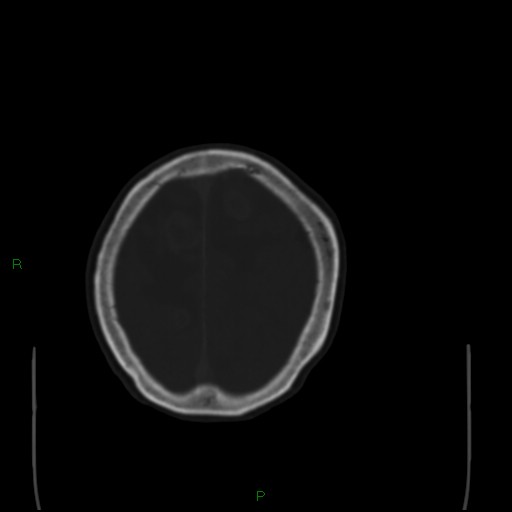 Cerebral metastases - breast primary (Radiopaedia 77653-89857 Axial bone window 98).jpg