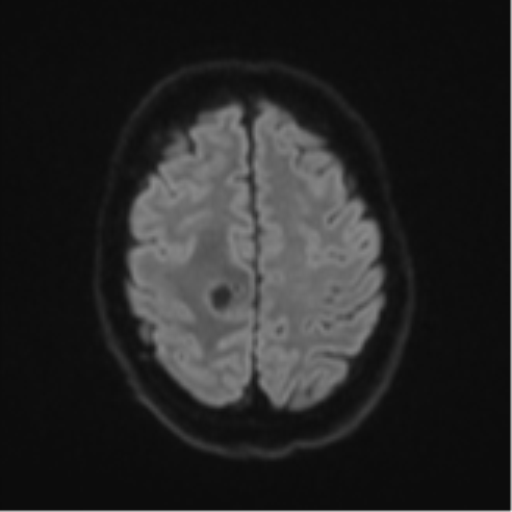 Cerebral metastasis - colorectal adenocarcinoma (Radiopaedia 50394-55765 Axial DWI 50).png