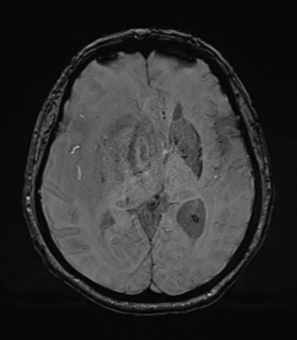 Cerebral metastasis to basal ganglia (Radiopaedia 81568-95413 Axial SWI 42).png
