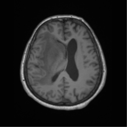 Cerebral metastasis to basal ganglia (Radiopaedia 81568-95413 Axial T1 45).png