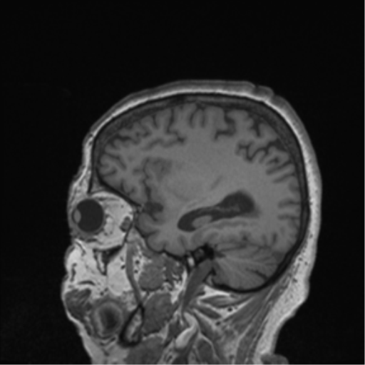 Cerebral metastasis to basal ganglia (Radiopaedia 81568-95413 Sagittal T1 18).png