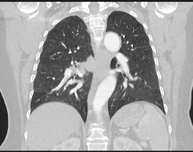 File:Cerebral metastasis to basal ganglia (Radiopaedia 81568-95414 Coronal lung window 55).png