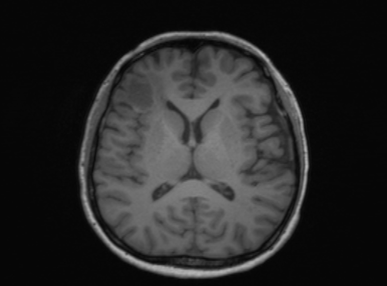 Cerebral ring enhancing lesions - cerebral metastases (Radiopaedia 44922-48817 Axial T1 214).jpg