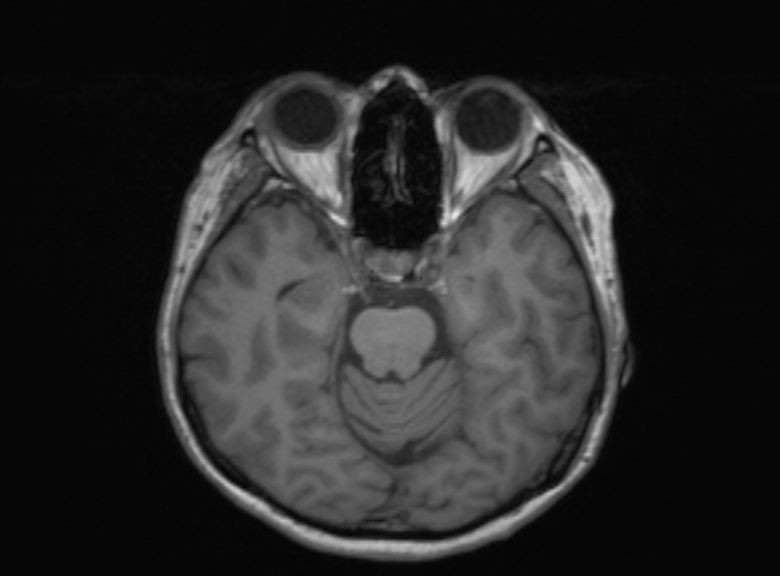 Cerebral ring enhancing lesions - cerebral metastases (Radiopaedia 44922-48817 Axial T1 271).jpg